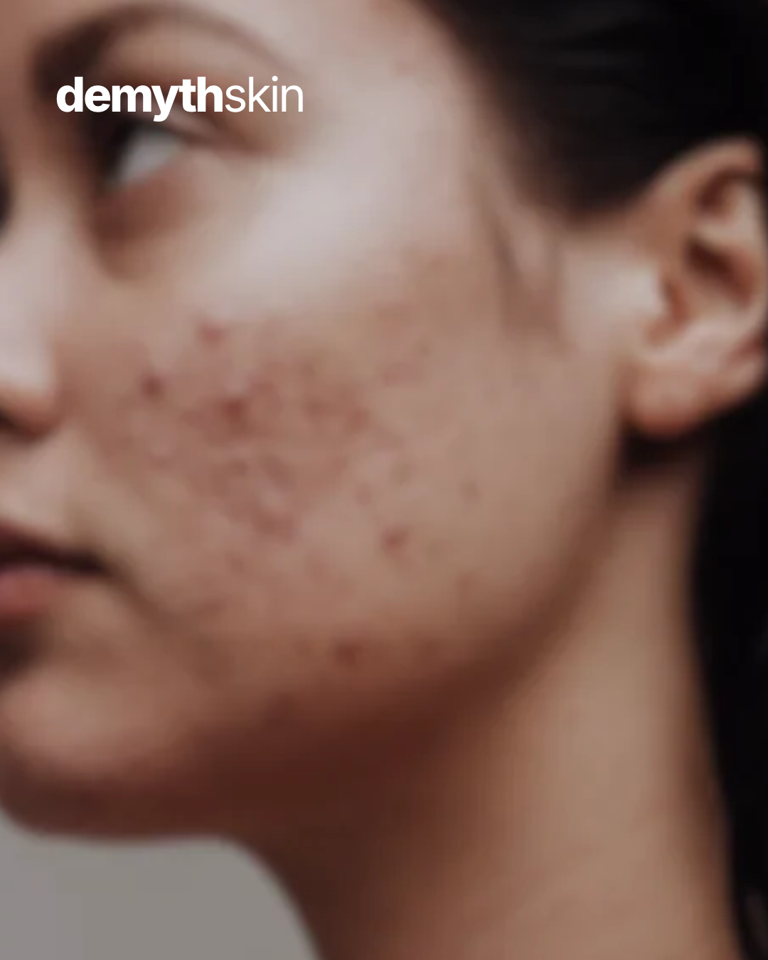 acne otc treatments, 
best moisturizer for acne prone skin, 
acnes gentle cleanser